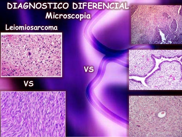 leiomiosarcoma uterino